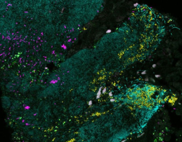 biofilm bakteri, kanker usus besar