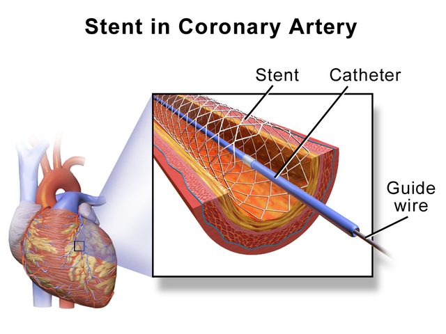 Stent di arteri koroner.