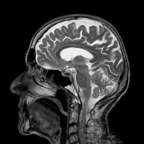 MRI, otak